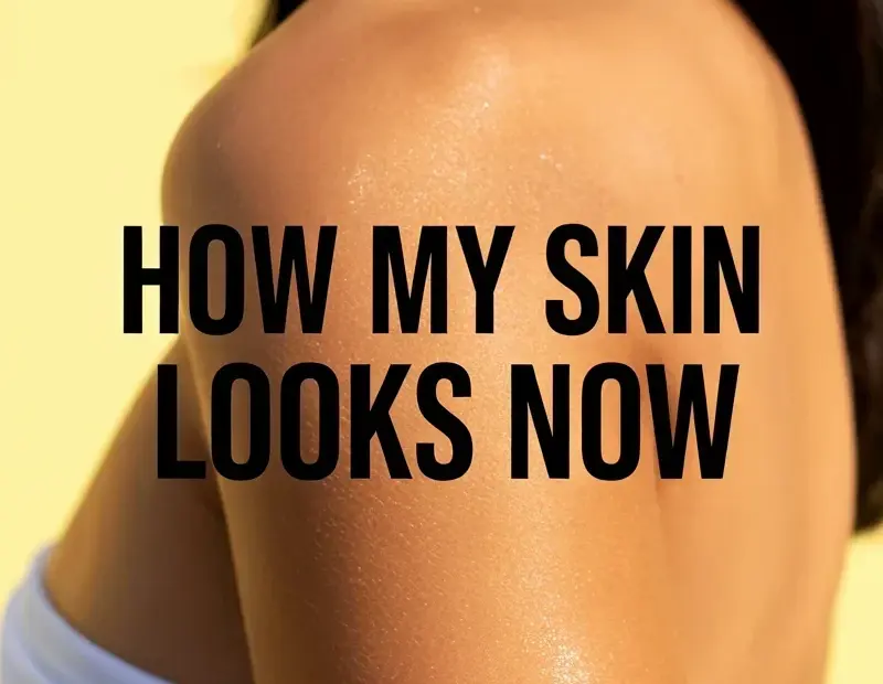 My back acne routine mistake: I ignored my body until I tried beldi soap