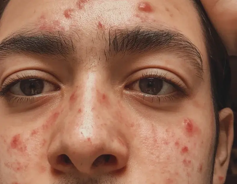 Acne-Prone Skin Selfie: How I Calm Redness & Breakouts